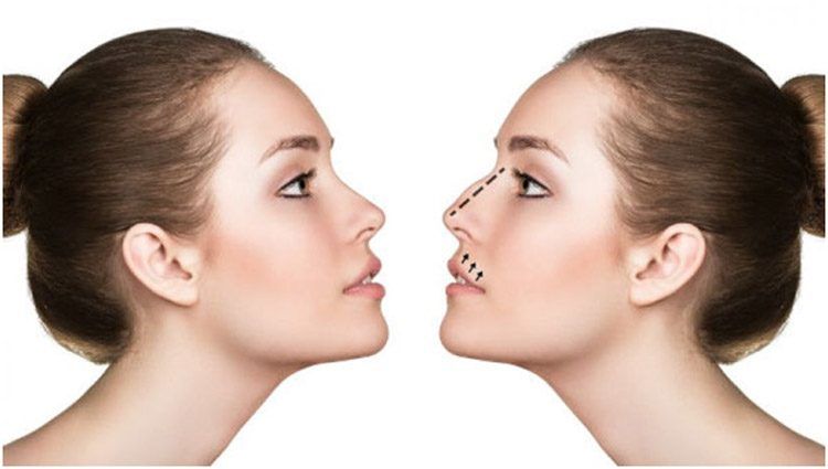 Rinoplastia: la intervención ideal para dotar de armonía al rostro